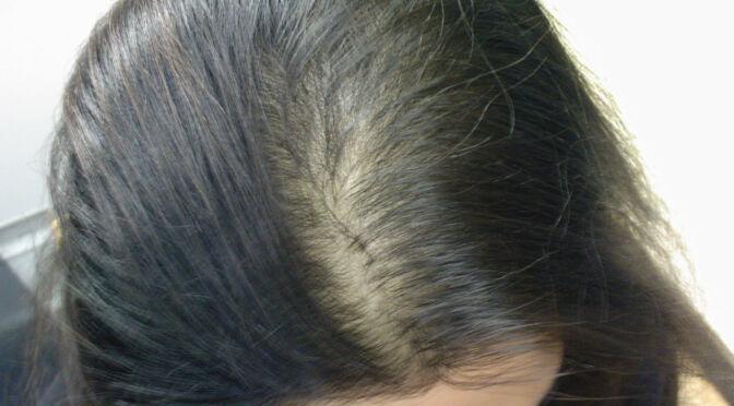 alopecia-androgenetica-femminile-cause-1024x779-1-672x372