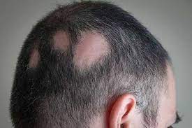 alopecia areata uomo